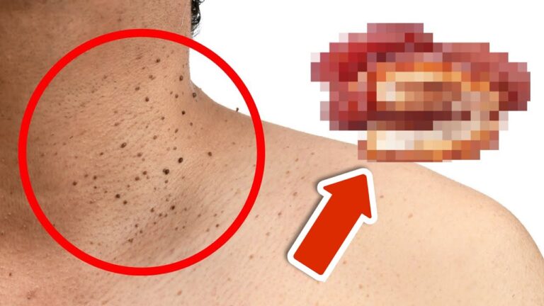 Scopri 5 cibi sorprendenti che possono causare fastidiosi problemi alla pelle!