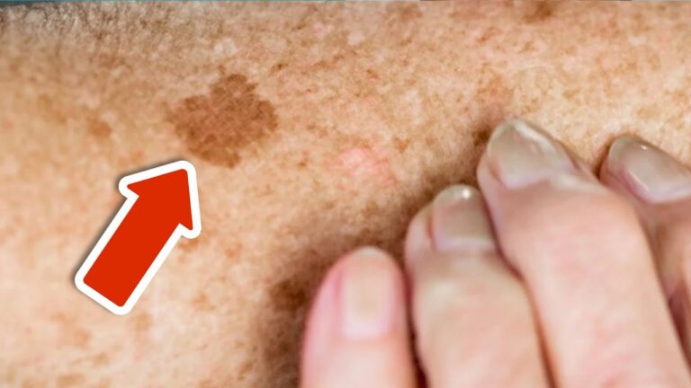 Scopri 5 vitamine per eliminare le macchie della pelle per sempre