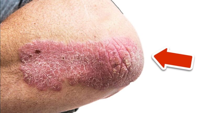 Scopri 5 vitamine che possono eliminare la psoriasi per sempre!