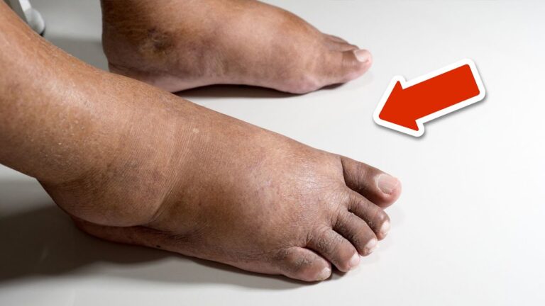 3 semplici vitamine per ridurre gonfiori in piedi e gambe! Scopri subito come!
