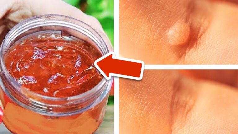 Scopri 5 rimedi naturali per liberarti definitivamente delle verruche!