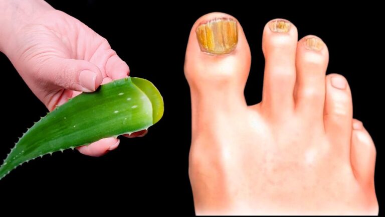 Elimina il fungo alle unghie: 5 vantaggi sorprendenti dell’aloe vera!