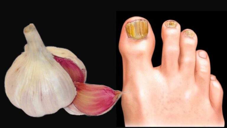 Rimuovi il 100% del nagelpilz con questo semplice rimedio naturale!