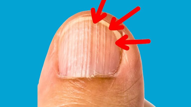 5 Segreti Svelati: Le Cause delle Linee Verticali sui Tuoi Unghie!